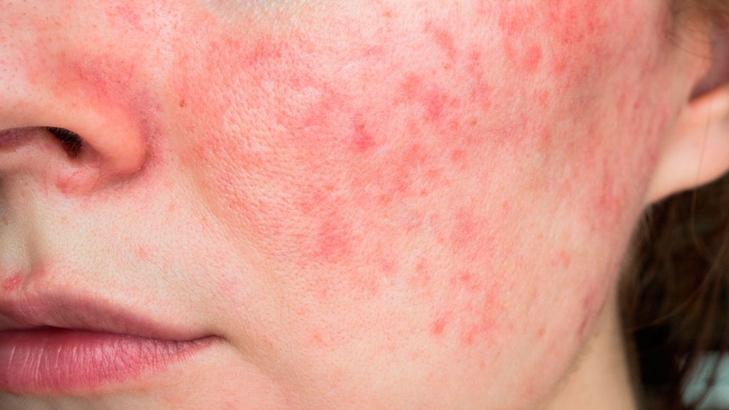 rosacea cuperosis acne 1